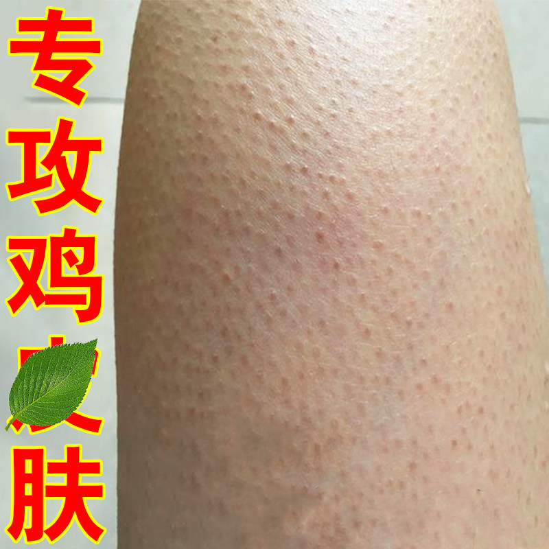 疙瘩毛囊角化膏毛周角化症去腿上粗糙颗粒