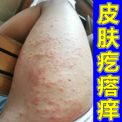 身上痒起红疙瘩痘腿上起红点全身皮肤干燥痒专用软膏