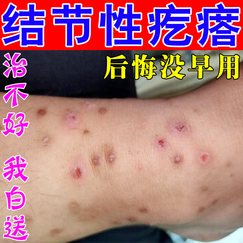 结节性痒皮肤膏治腿上硬疙瘩红肿