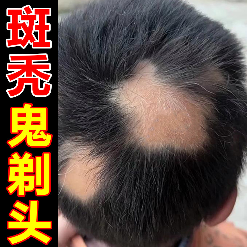 斑秃鬼剃头突发性头部脱发秃顶成人儿童适用育发密发精华液