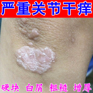 手肘痒胳膊关节手臂脖子发痒皮肤脱皮干燥起干皮专用软膏