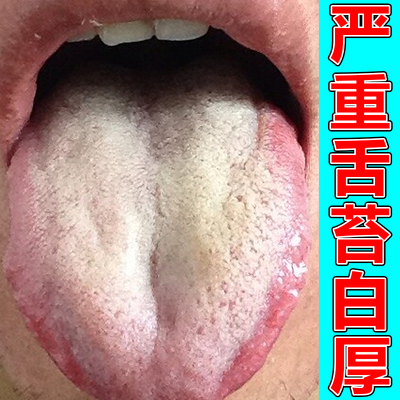 舌苔白厚腻有齿痕调理脾胃湿气重脾胃虚寒肝火旺调理膏贴