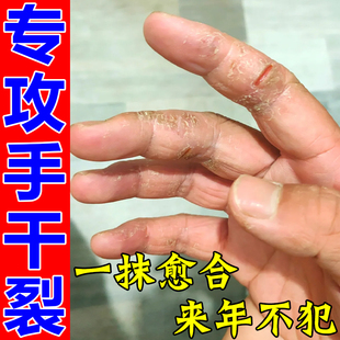 手干裂修复膏手指裂口干裂粗糙手指头开裂口流血疼痛脱皮