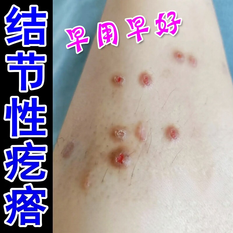 结节性痒专用冶顽固硬疙瘩全身皮肤痒外用软膏