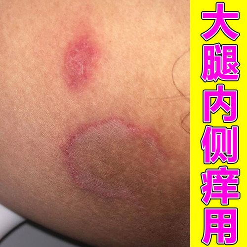大腿内侧烧裆走路摩擦膏男女士通用出汗多红肿刺痛痒