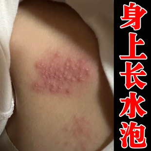 专冶蛇盘蛇缠腰的药身上腰侧长密集小水泡疙瘩疼痛带状痒软膏