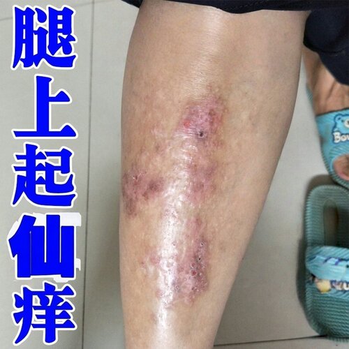 腿上痒小腿痒腿部发痒腿上起红疙瘩红点感染真软膏外用