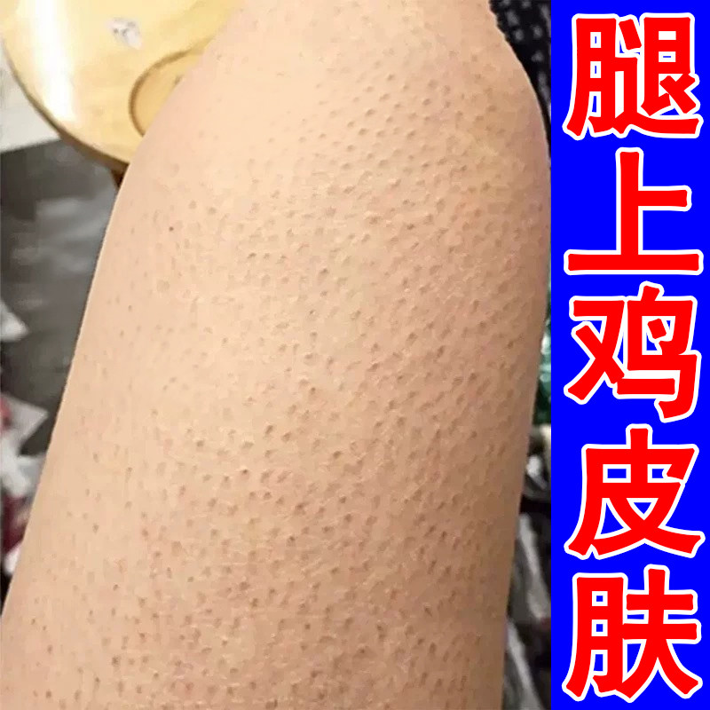 鸡皮疙瘩毛囊角化去腿上小疙瘩颗皮肤消毒护理（消）