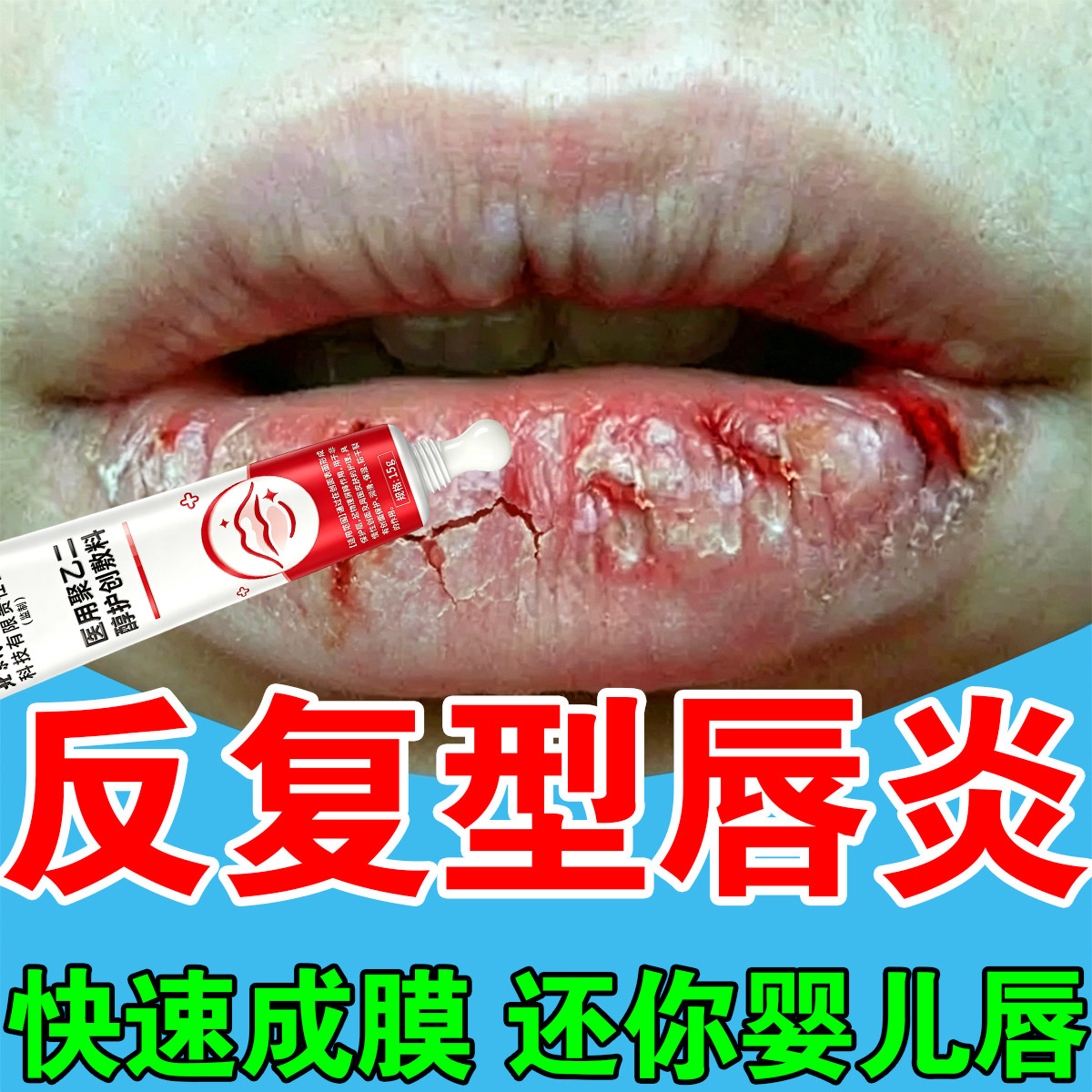 唇炎专用膏嘴唇干裂脱皮医用型儿童成人剥脱性口角炎烂嘴角润唇膏