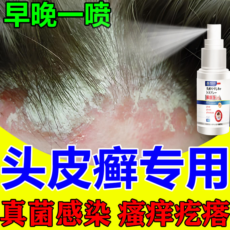 头皮癣专用头皮屑脂溢性皮炎真菌感染头皮痒起疙瘩毛囊炎头藓喷剂