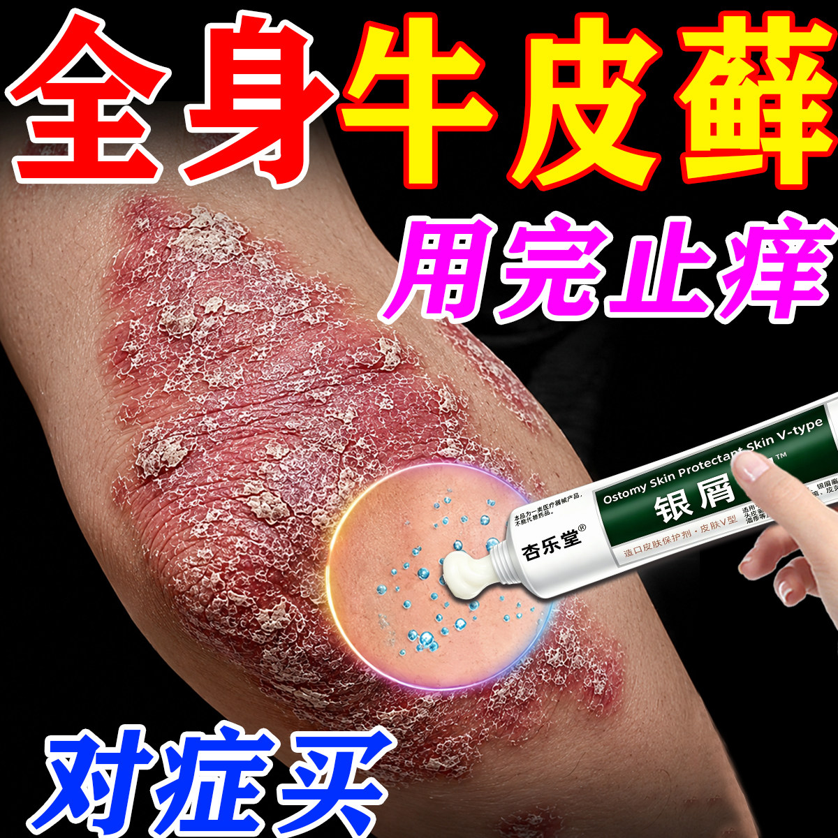 牛皮藓癣银屑病专用顽固银屑病铜钱体癣真菌感染头皮癣花斑癣乳膏