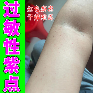紫点专用膏过敏性老年色素皮下出血腿上长红点瘀斑皮肤血斑点血热