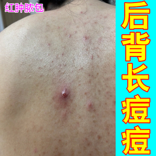 后背长痘痘前胸后背红肿脓包前胸螨虫痘坐疮疙瘩脓包去淋巴玫瑰疮