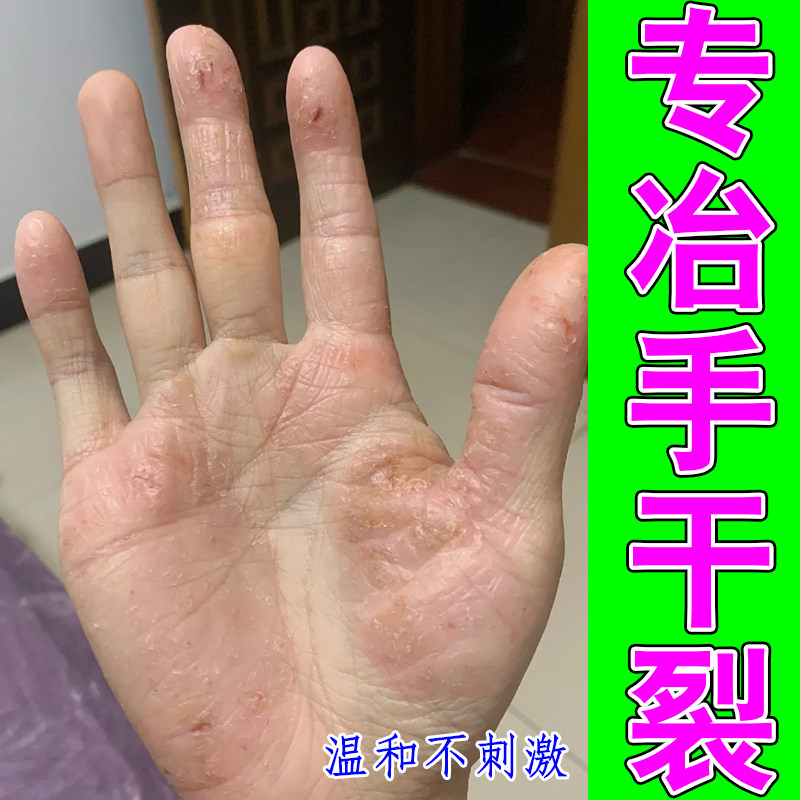 专冶手干裂掉屑起皮红肿皮肤角质粗糙干燥裂口子指腹脱皮红肿专用