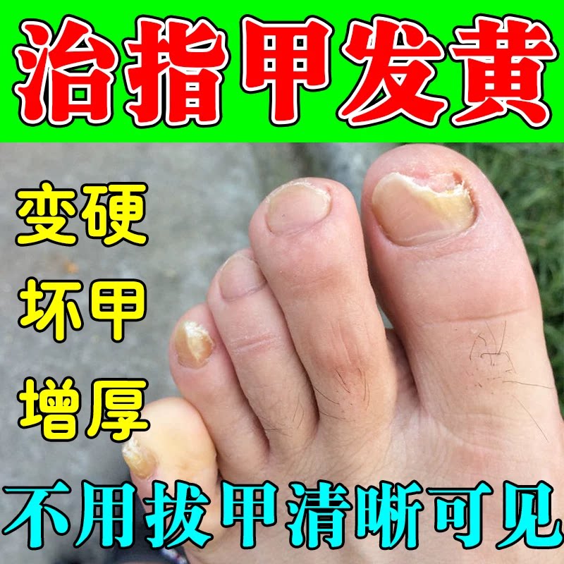 脚指甲发黄变厚变硬治增厚白甲空甲修复甲分离脱落软化营养修复液