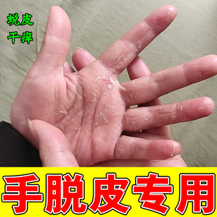 手指脱皮儿童手蜕皮严重干裂手裂口子干燥粗糙手上起皮药