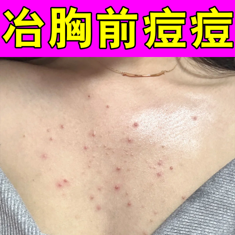 冶胸前痘痘皮肤干燥粗糙起红疙瘩马拉色菌毛囊堵塞毛孔粗大外用药