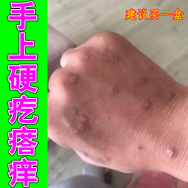 手上硬疙瘩痒小腿黑色素沉淀腿上皮肤粗糙起痘痘硬块感染长红点痒