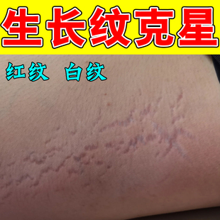 去肥胖纹修复霜生长纹消除学生大腿淡化妊娠纹精油祛紧致肚皮膏