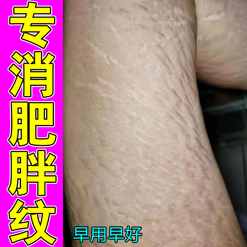 去肥胖纹身上生长纹妊娠纹冶青少年大腿腹部长纹横纹萎缩纹膨胀纹