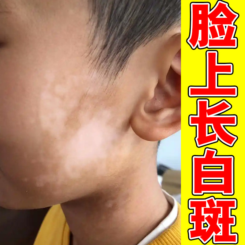 白颠风药乳快速消白斑专用外用黑色素生长补骨脂酊遮盖液神器