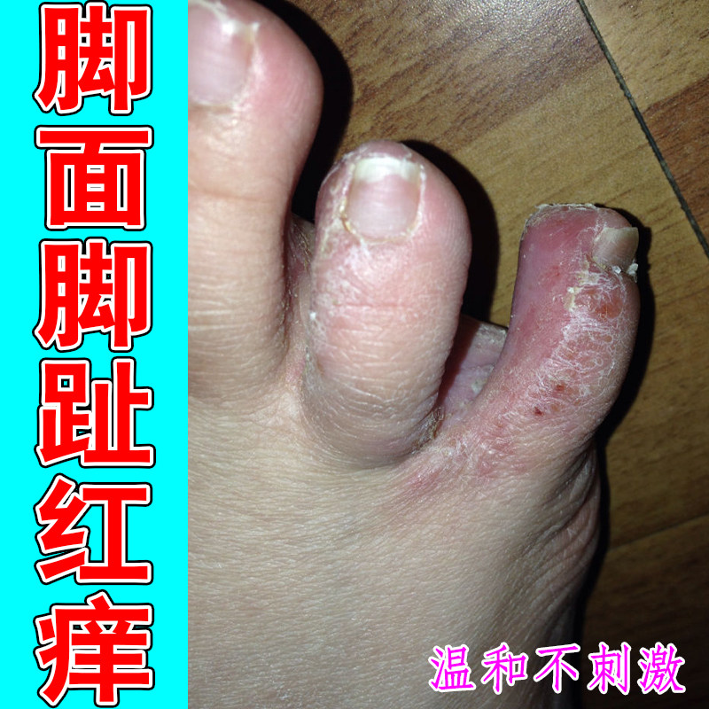 脚面脚趾红痒鳞屑角质型脚后跟粗糙痒刺挠起疹子挠一片红肿过敏痒