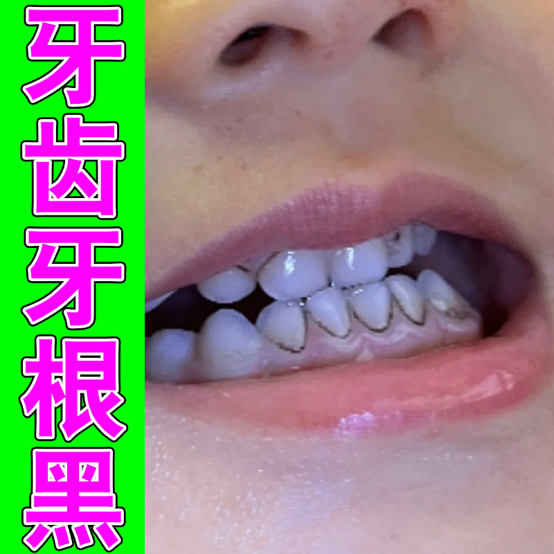 牙齿牙根黑牙菌斑儿童牙龋齿黑牙黄牙垢洗牙剂去黑线黑黄渍牙斑净