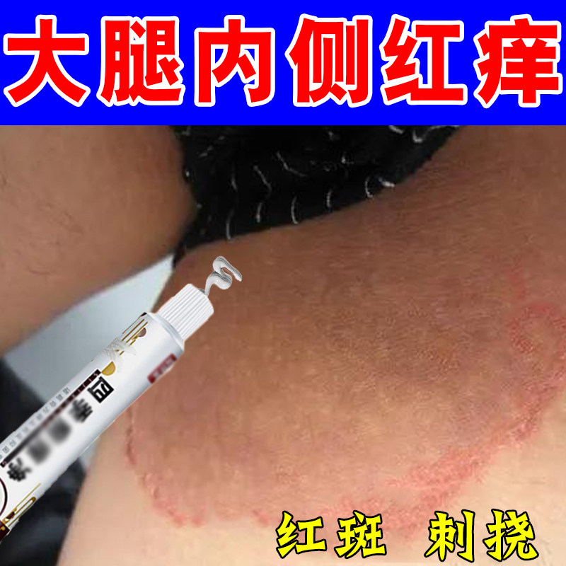 大腿内侧皮肤痒刺挠干燥粗糙腿根部红肿长红斑刺痛红保药霜