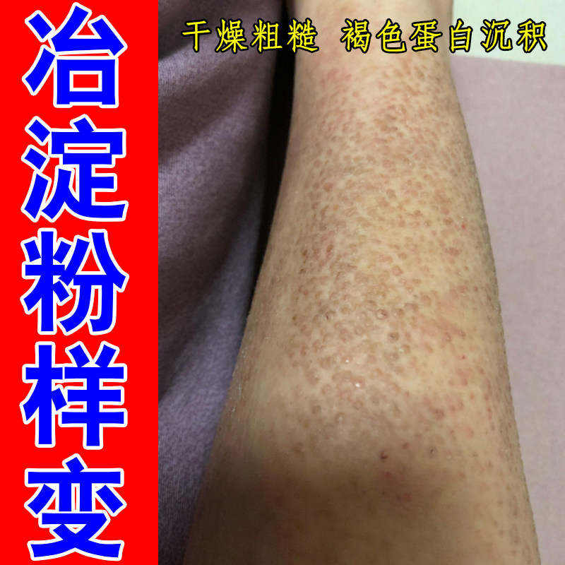 皮肤顽固褐色斑点剧烈干痒改善皮肤粗糙颗粒蛋白沉积修复