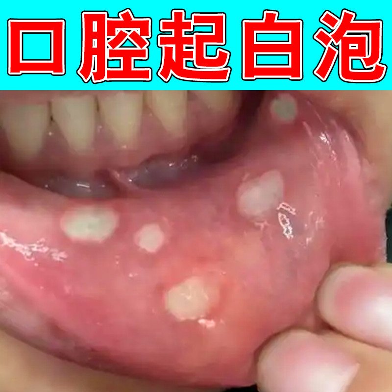 口腔护理液口舌生疮嘴巴烂内壁起泡舌面白点反复口腔不适吃饭刺痛