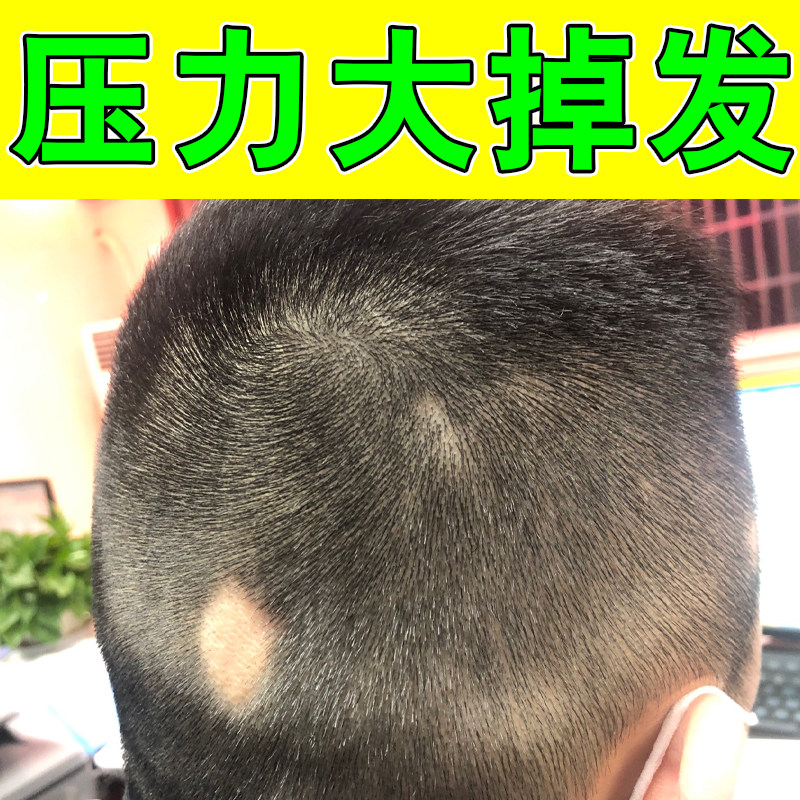 头顶斑秃掉发成片脱发头皮滋养精华中年青年头发块状脱落日常外用