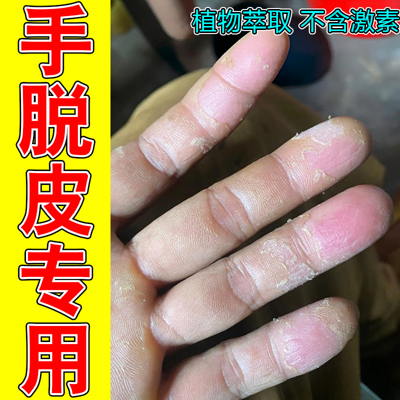 手脱皮专用季节性手掉屑蜕皮换季过敏手指上起皮干燥粗糙感染专用