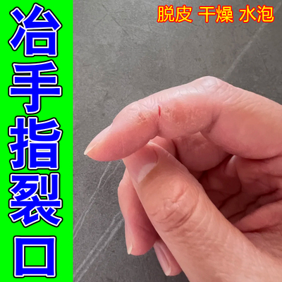 冶手指裂口皮肤干燥掉皮真菌脚底脱皮手指头开裂口皴裂手指头粗糙
