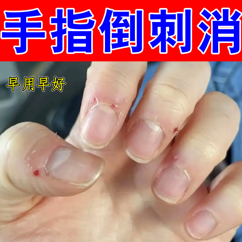 手指倒刺消手指干燥粗糙掉屑指甲边缘长肉刺死皮撕裂脱皮疼痛保湿