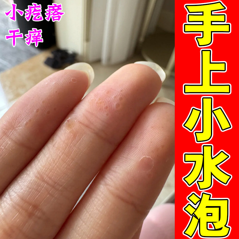 手上长小水泡手脱皮干燥手指粗糙起皮手干裂手掌爆皮专用修复药乳