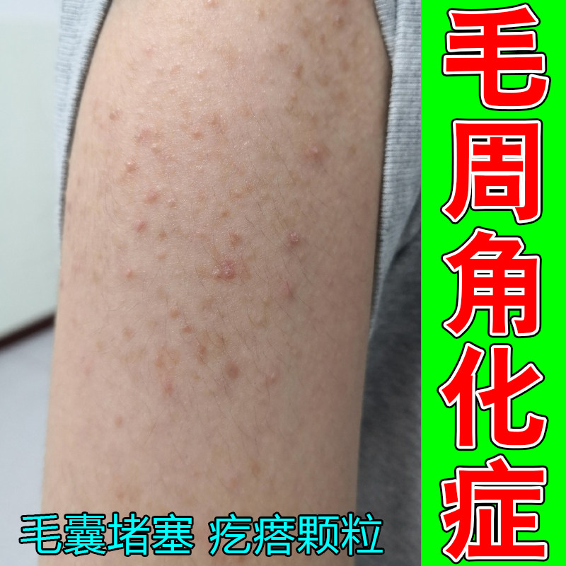 毛周角化上臂外侧角质堆积毛囊堵身体乳/霜