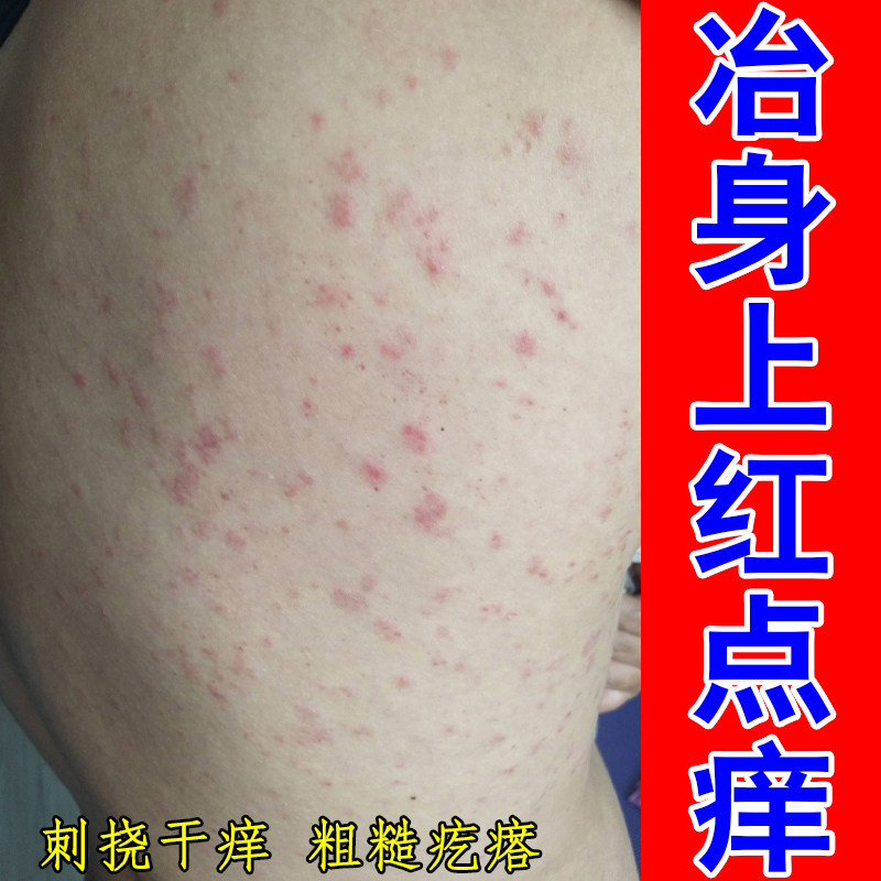 冶身上红点痒粗糙干燥掉屑皮肤疙瘩痒背后刺挠一抓一片红肿过敏痒