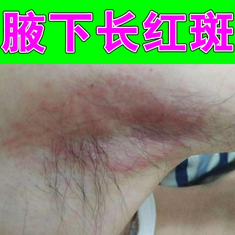 腋下长红斑汗斑药专用软膏玫瑰斑痒花斑白斑红褐斑红痒皮肤外用药