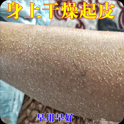 腿上干燥起皮小腿皮肤痒秋冬天起皮掉皮屑腿部鱼鳞补水保湿修复霜