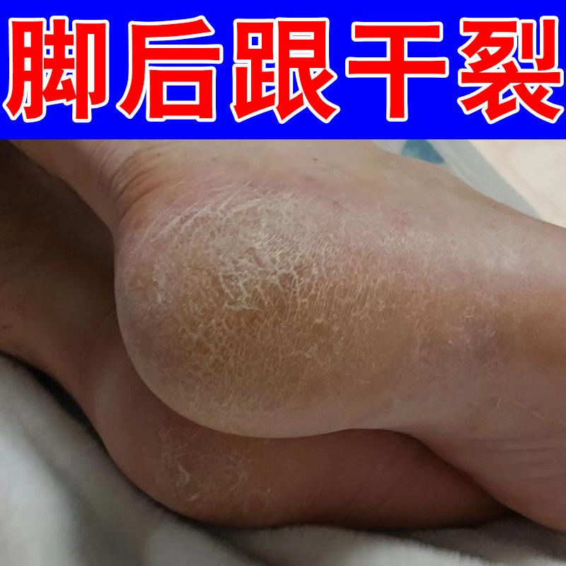 脚后跟干裂蜕皮手指粗糙裂口严重角化型脚粗糙干燥脱皮草本修护药