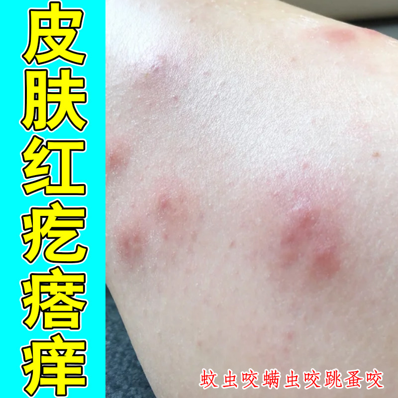 皮肤红疙瘩痒秋冬天气冷换季过敏痒粗糙干燥痒掉屑长红斑长痘痘痒