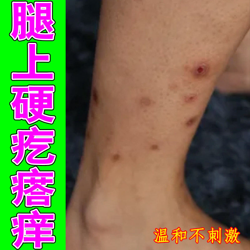 腿上硬疙瘩痒掉屑红肿皮肤粗糙痒一抓一片红长红斑硬块疙瘩痘草本