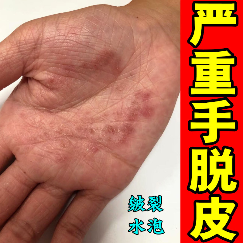 手干裂起皮角化型手长硬疙瘩脱皮开裂去死皮修复药