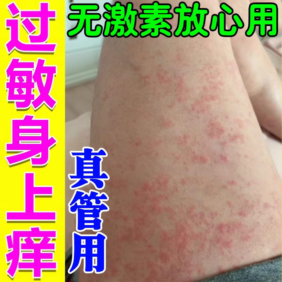 专治皮肤干燥过敏药夏天小腿皮肤痒腿上全身起小红点疙瘩专用乳膏