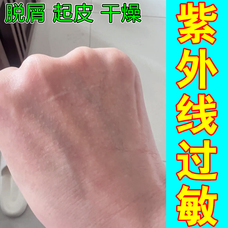紫外线过敏膏药皮肤晒伤修复日光性掉屑紫外线过敏晒伤干痒泛红药,保健用品,皮肤消毒护理（消）,淘宝优惠券,粉丝福利购,淘宝优惠卷