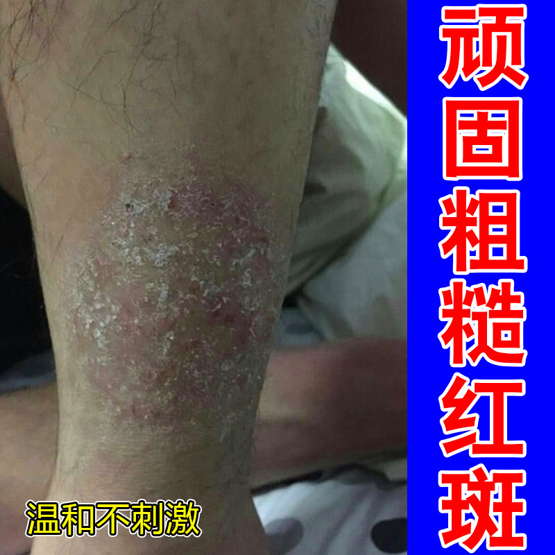 顽固粗糙红斑褐色颗粒干燥痒黑色素沉淀小腿后背蛋白沉积顽固痒膏