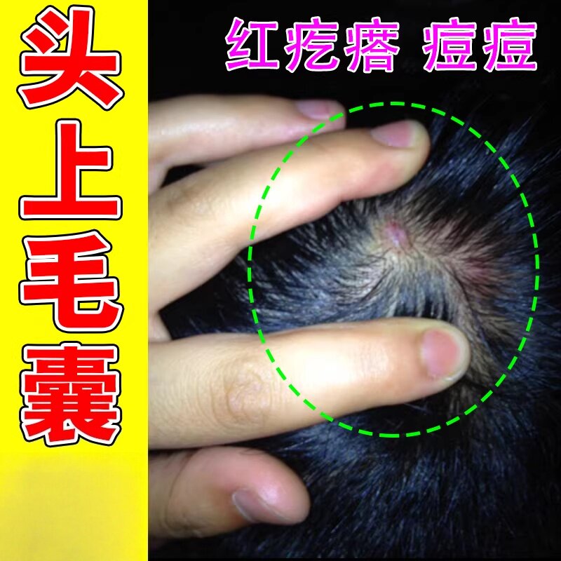 头上毛囊堵塞头上长痘痘严重头屑头痒起屑头上脸上疙瘩毛囊堵塞