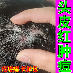 头上长疙瘩的药头皮长痘痘红肿干燥痒真菌感染头痒头螨出油脓包痘