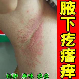 腋下痒长红疙瘩起干皮胳肢窝长痘痘红肿过敏性干燥粗糙腋窝红淹药