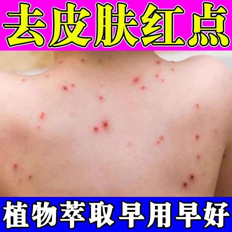 夏天皮肤的痒药身起上疙红瘩长小红点前胸后背长痘痘发痒专用